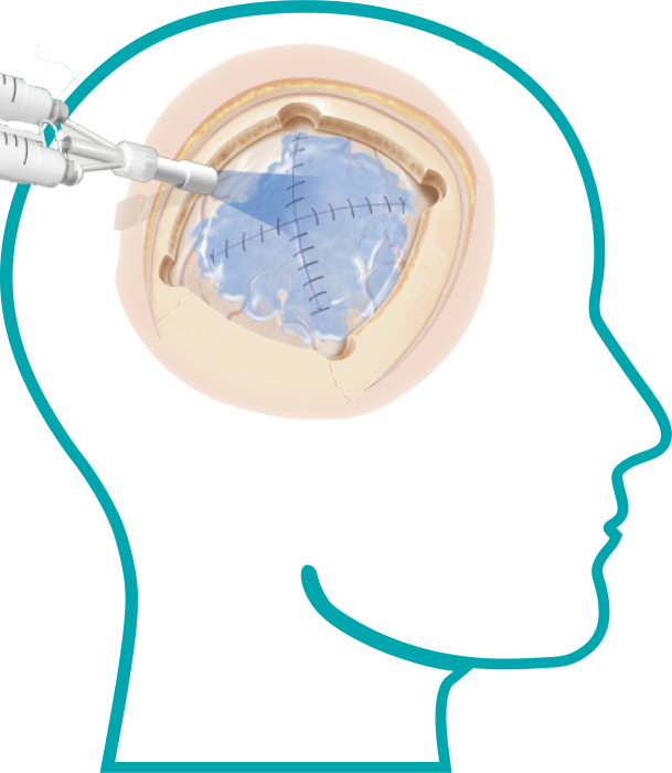 可吸收硬腦膜封合醫(yī)用膠照片1