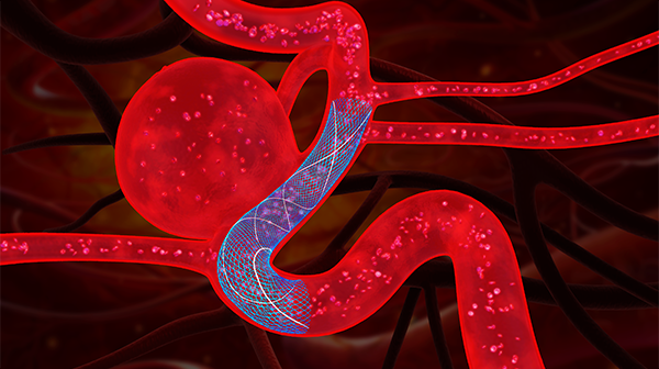 微創神通_血管重建裝置_圖片3