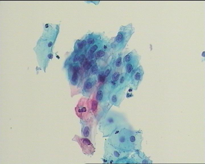 圖4 不能明確意義的非典型鱗狀上皮細(xì)胞（ASC-US）