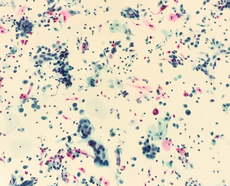 圖9 鱗狀細(xì)胞癌細(xì)胞（SCC）